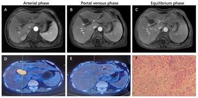 Case report: Translational treatment of unresectable intrahepatic cholangiocarcinoma: Tislelizumab, Lenvatinib, and GEMOX in one case